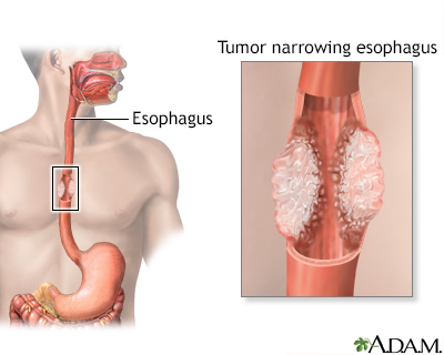 Esophageal cancer