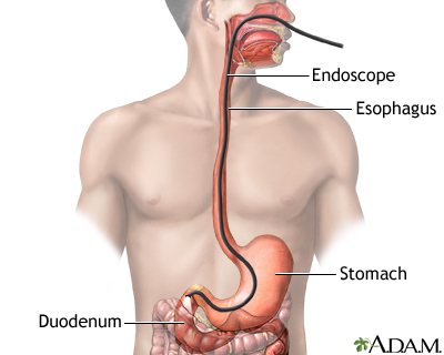 Esophagogastroduodenoscopy (EGD)