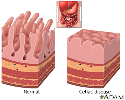 Celiac disease