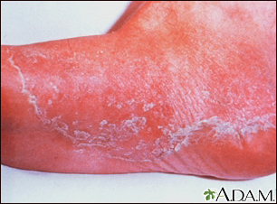 Athlete's foot - tinea pedis