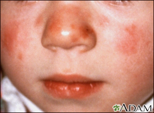 Lupus - discoid on a child's face