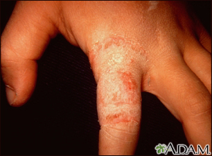 Ringworm - tinea manuum on the finger