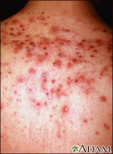 Acne - close-up of cysts on the back