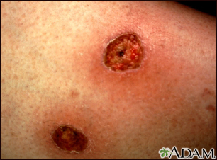 Ecthyma gangrenosum