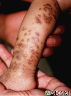 Incontinentia pigmenti on the leg