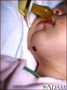 Hemangioma on the chin