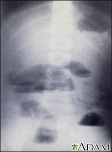 Small bowel obstruction - X-ray