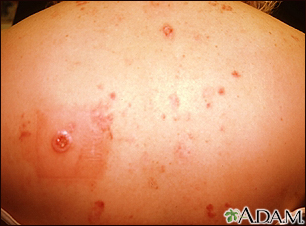 Multiple Basal cell cancer due to x-ray therapy for acne