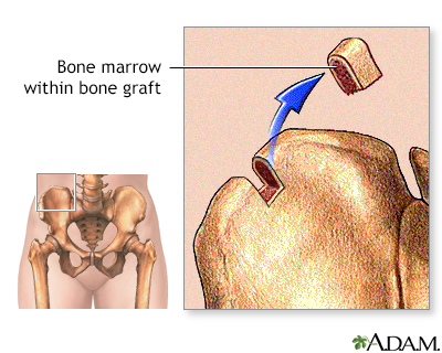 Bone marrow from hip