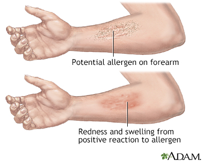 Positive reaction to allergen