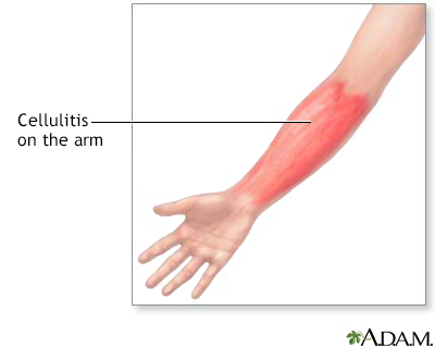 Cellulitis on the arm