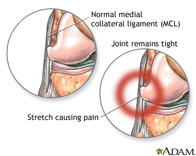 Lateral collateral ligament pain