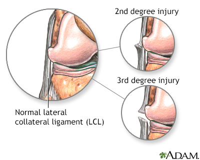 Lateral collateral ligament injury