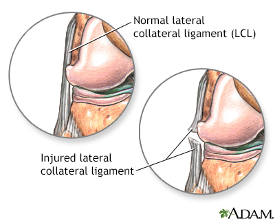 Torn lateral collateral ligament