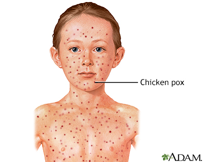 Chickenpox