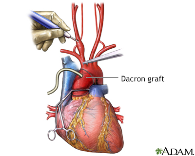 Prosthetic graft placement