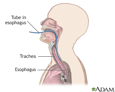 Esophageal pH monitoring