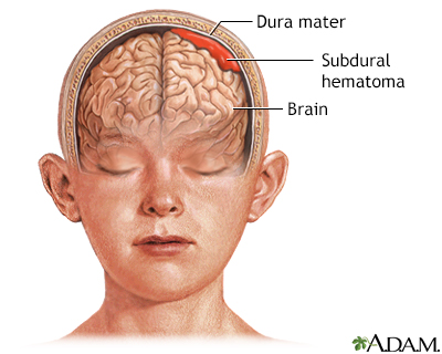 Subdural hematoma