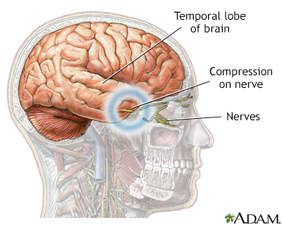 Brain herniation