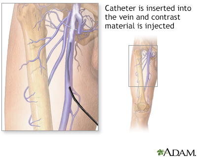 Leg venography