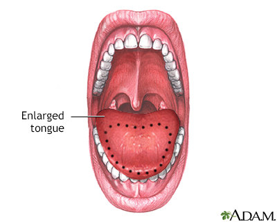 Macroglossia