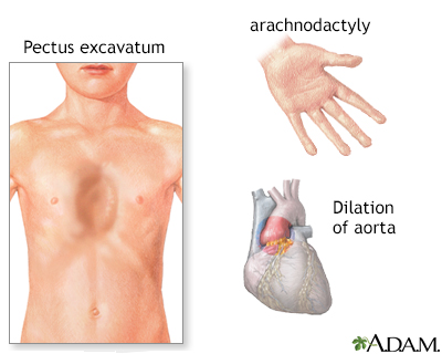 Marfan syndrome