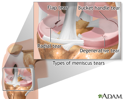 Meniscal tears