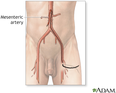 Mesenteric arteriography