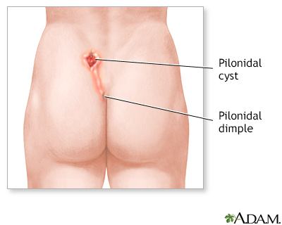 Pilonidal dimple