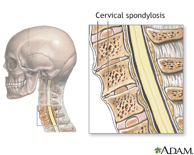 Cervical spondylosis