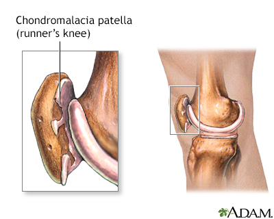 Runners knee