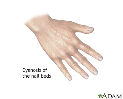 Cyanosis of the nail bed