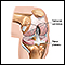 Knee joint replacement - Normal anatomy